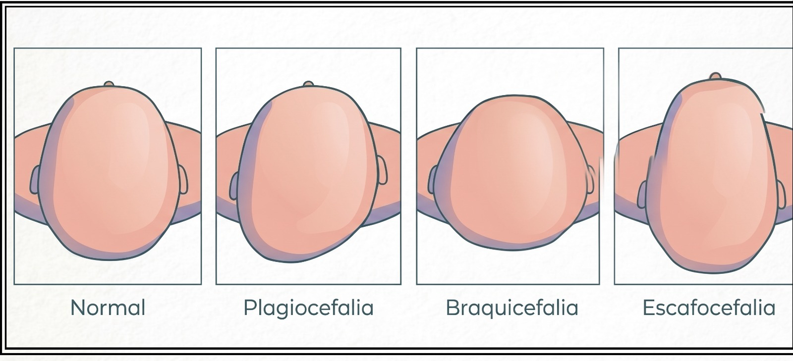 Formatos de cabeça: normal, plagiocefalia e braquicefalia